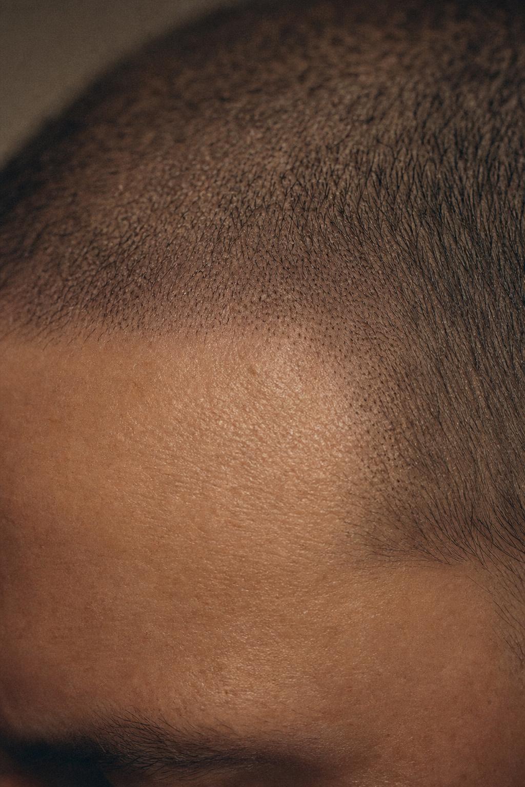 Detail einer Scalp Micropigmentation am Haaransatz
